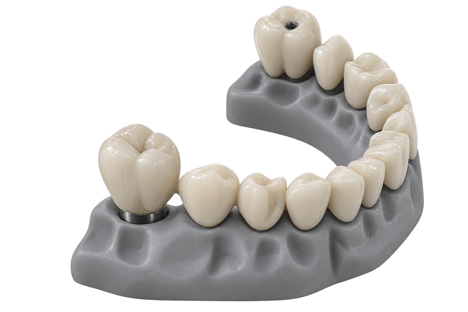 CAD-designed crowns and bridges on a dental model